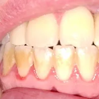 Gums